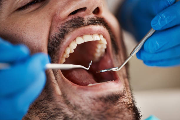 Best Emergency Wisdom Teeth Removal in Barneveld, WI